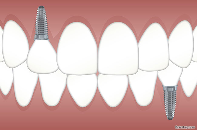 Vorteile eines Zahnimplantats gegenüber losem Zahnersatz